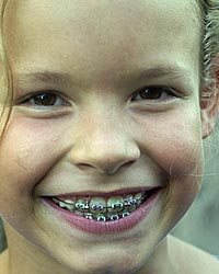 photo of a young smiling girl undergoing dentofacial orthodedics